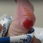 “Fiquei péssima com o ocorrido” afirma secretária após queimadura de segundo grau em bebê durante teste do pezinho