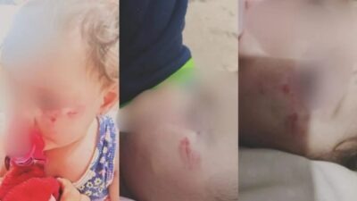 Bebê de 1 ano sofre lesões por mordidas na escola particular Educart Baby e Kids, em Divinópolis
